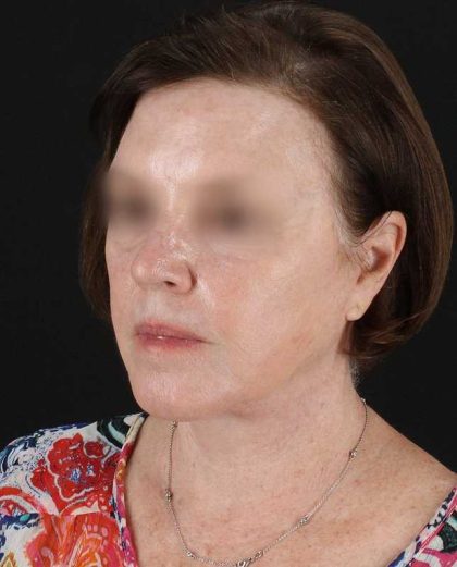 All Me Facelift Before & After Patient #354