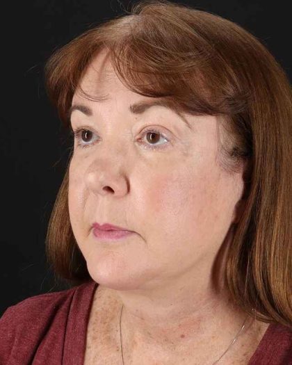 All Me Facelift Before & After Patient #366
