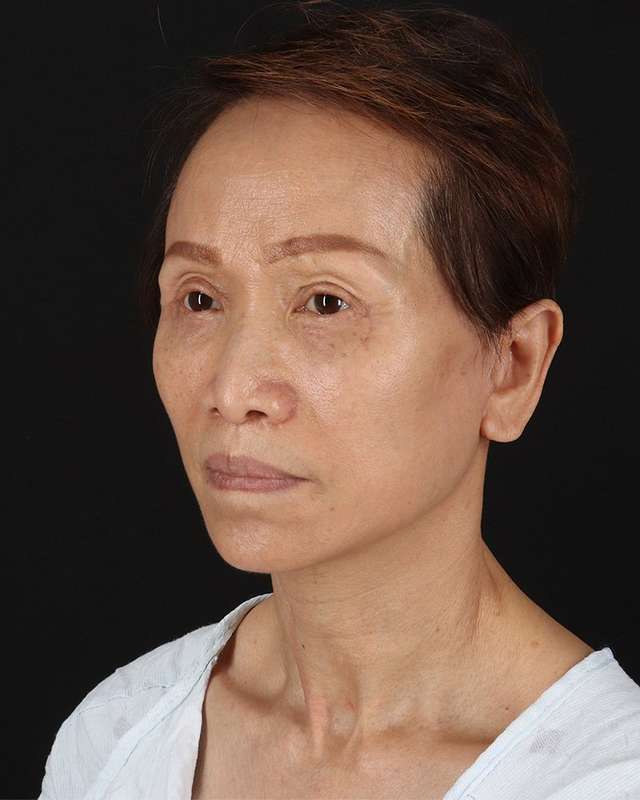 All Me Facelift Before & After Patient #395