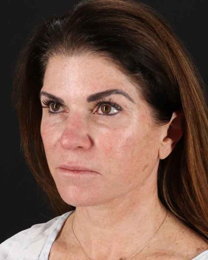 All Me Facelift Before & After Patient #406