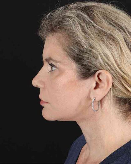 All Me Facelift Before & After Patient #428