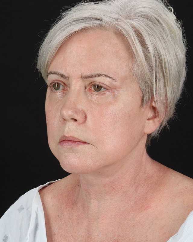 All Me Facelift Before & After Patient #439