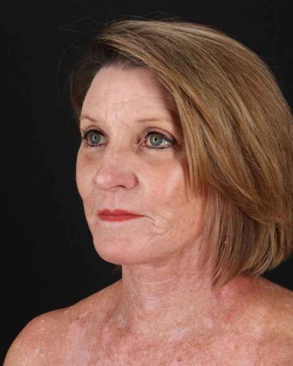 All Me Facelift Before & After Patient #461