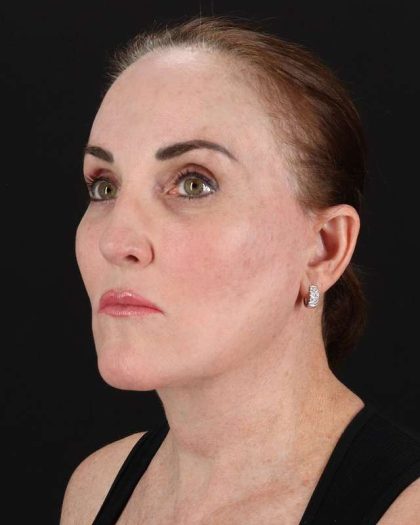 All Me Facelift Before & After Patient #472