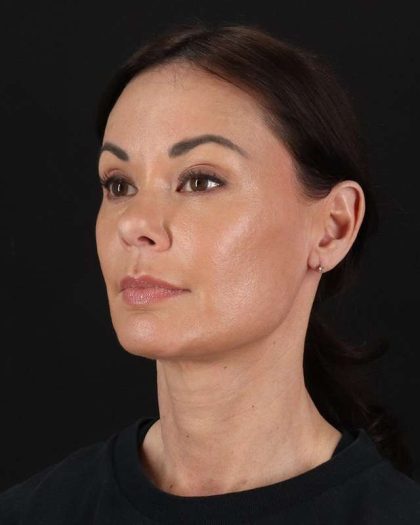 All Me Facelift Before & After Patient #483