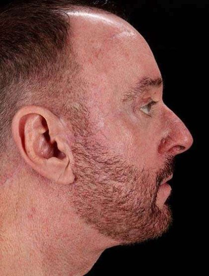 All Me Facelift Before & After Patient #728