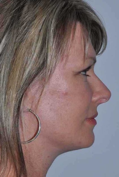 All Me Facelift Before & After Patient #781