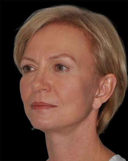 All Me Facelift Before & After Patient #274