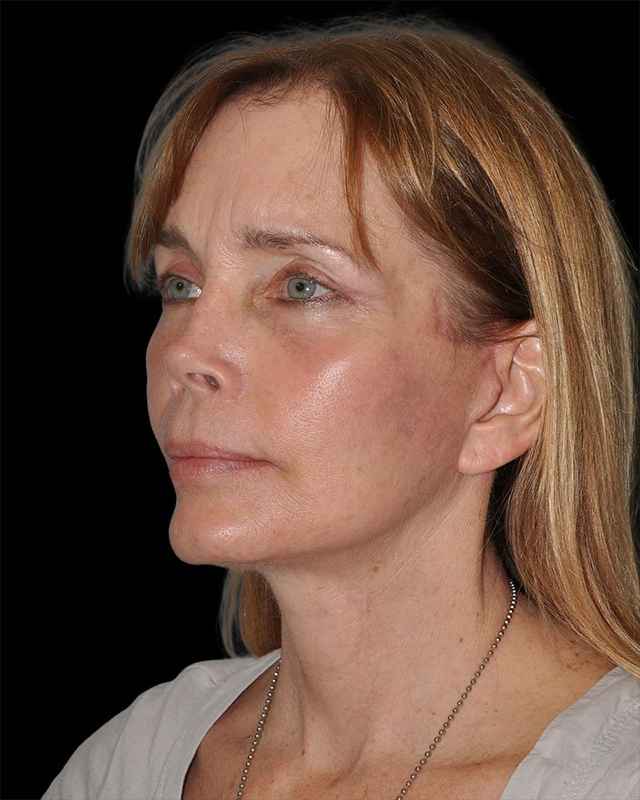 All Me Facelift Before & After Patient #297