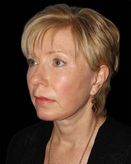 All Me Facelift Before & After Patient #308