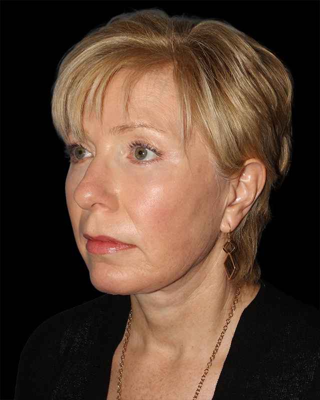 All Me Facelift Before & After Patient #308