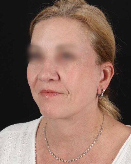 All Me Facelift Before & After Patient #320