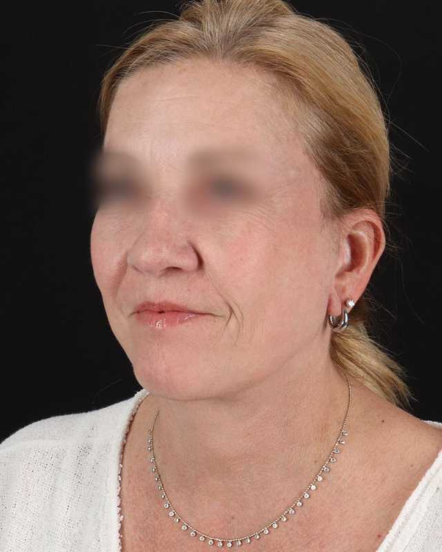 All Me Facelift Before & After Patient #320