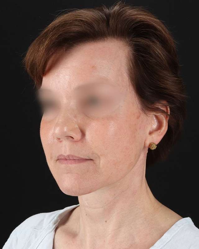 All Me Facelift Before & After Patient #229