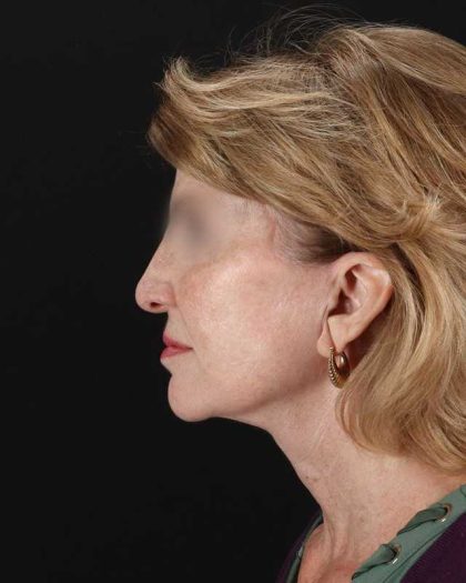 All Me Facelift Before & After Patient #240
