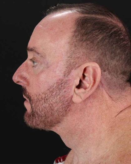 All Me Facelift Before & After Patient #343