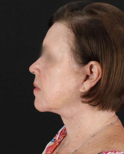 All Me Facelift Before & After Patient #354