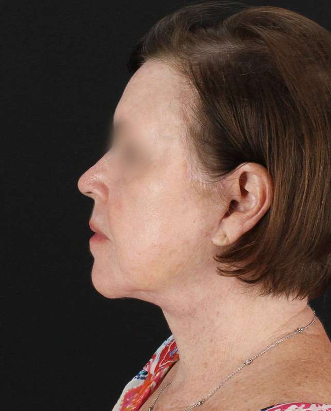 All Me Facelift Before & After Patient #354
