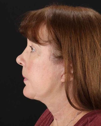 All Me Facelift Before & After Patient #366