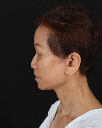 All Me Facelift Before & After Patient #395