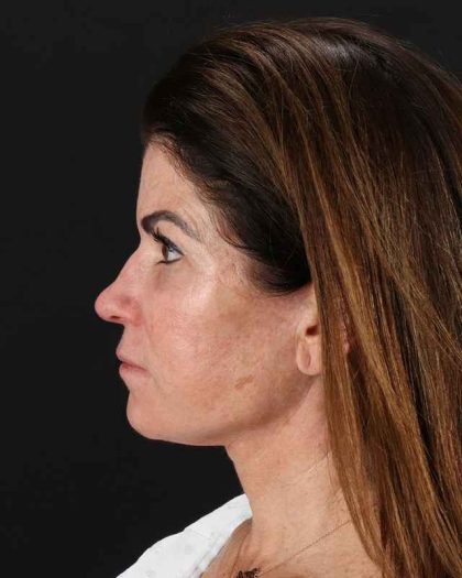All Me Facelift Before & After Patient #406