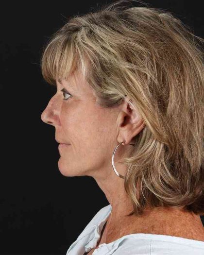 All Me Facelift Before & After Patient #418