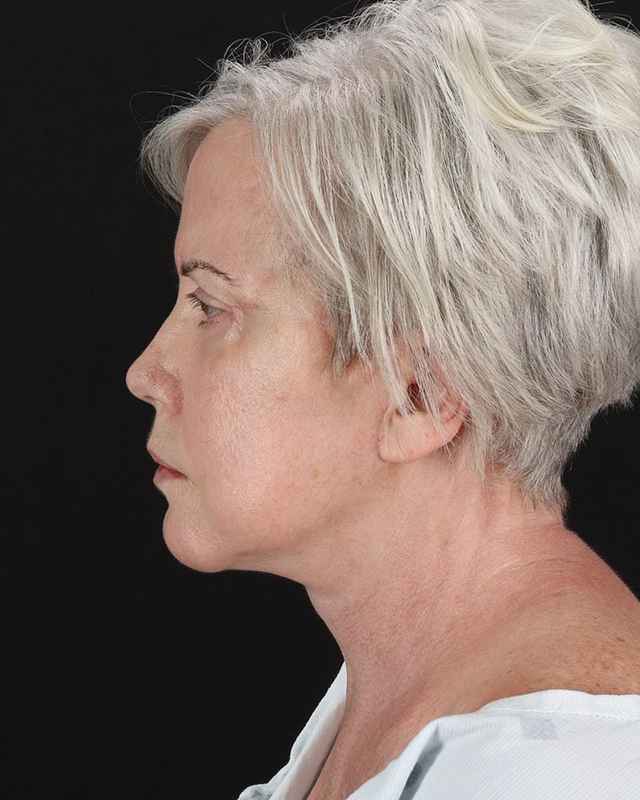 All Me Facelift Before & After Patient #439
