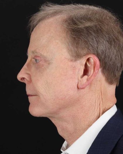 All Me Facelift Before & After Patient #450