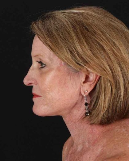 All Me Facelift Before & After Patient #461