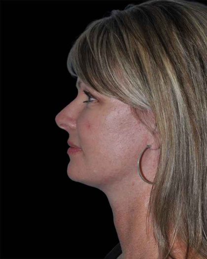 All Me Facelift Before & After Patient #252