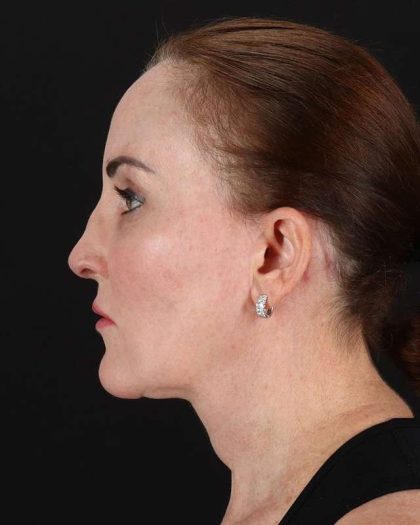 All Me Facelift Before & After Patient #472