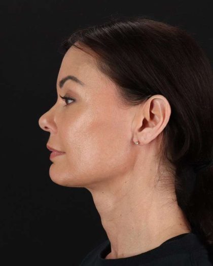 All Me Facelift Before & After Patient #483