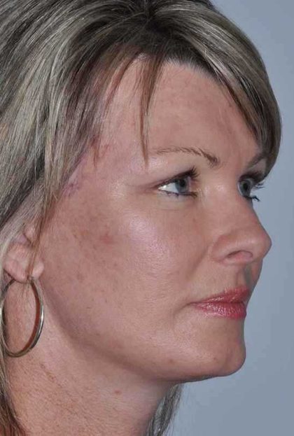 All Me Facelift Before & After Patient #781