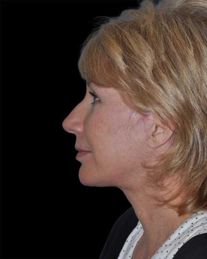 All Me Facelift Before & After Patient #263