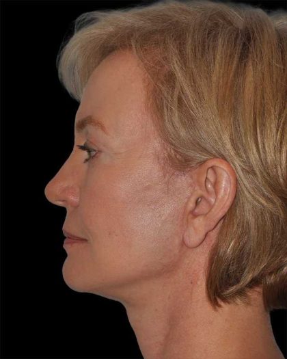 All Me Facelift Before & After Patient #274