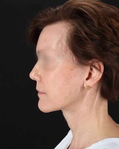 All Me Facelift Before & After Patient #229