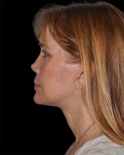 All Me Facelift Before & After Patient #297