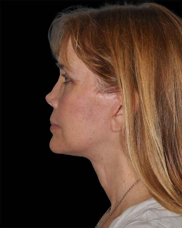 All Me Facelift Before & After Patient #297
