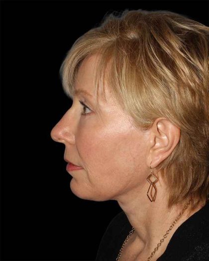 All Me Facelift Before & After Patient #308