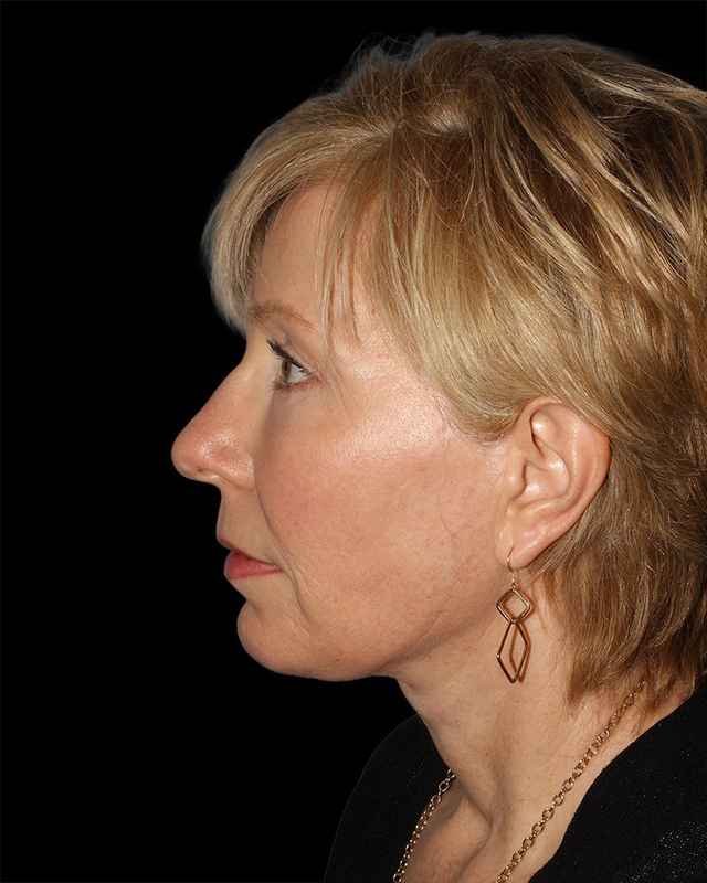 All Me Facelift Before & After Patient #308