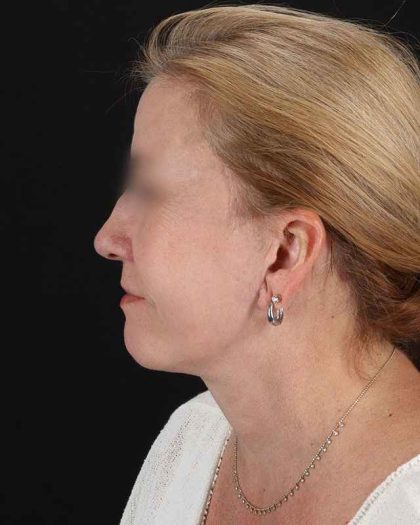 All Me Facelift Before & After Patient #320