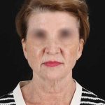 All Me Facelift Before & After Patient #240