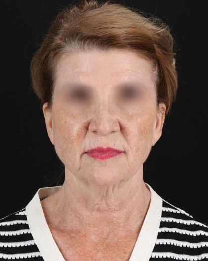 All Me Facelift Before & After Patient #240