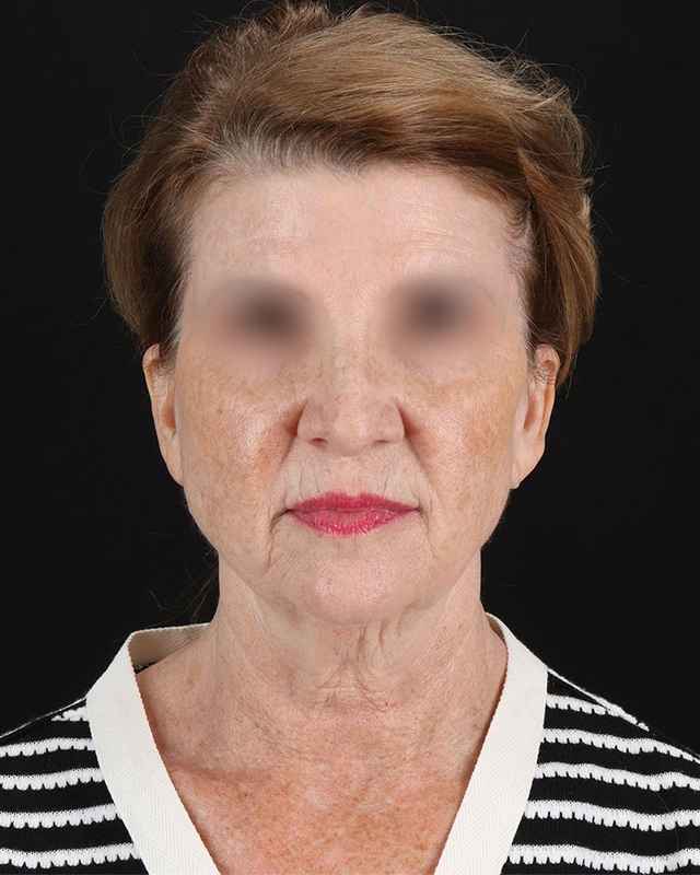 All Me Facelift Before & After Patient #240