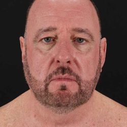 All Me Facelift Before & After Patient #343