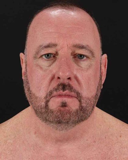 All Me Facelift Before & After Patient #343