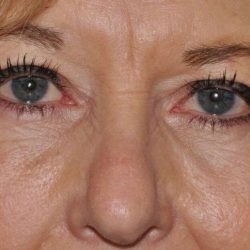 Blepharoplasty (Eyelid Surgery) Before & After Patient #930