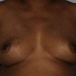 Nipple Areola Preservation (NAP) Before & After Patient #981