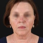 All Me Facelift Before & After Patient #354