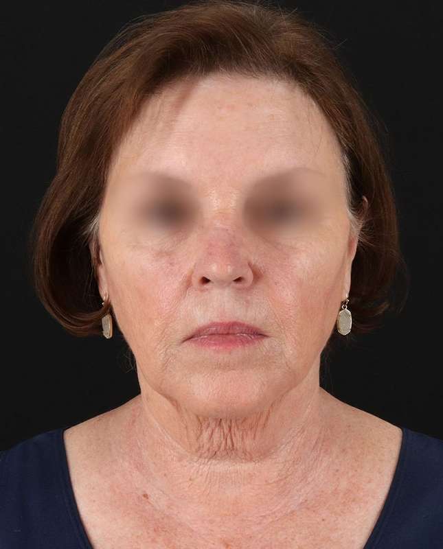 All Me Facelift Before & After Patient #354